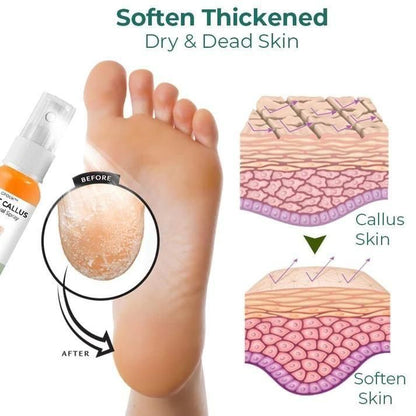 Foot Callus Removal Spray